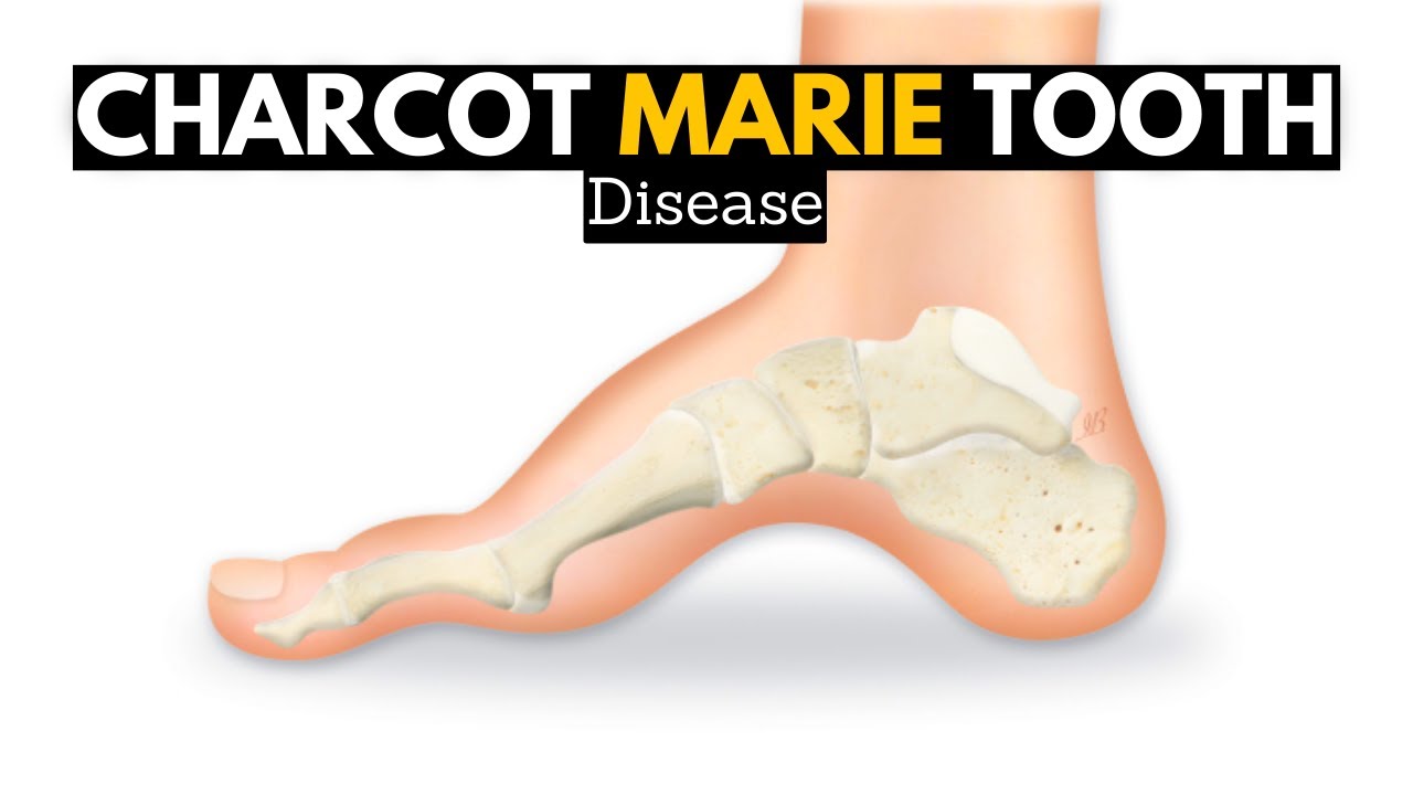 Charcot Marie Tooth Disease prevalence and incidence in the US
